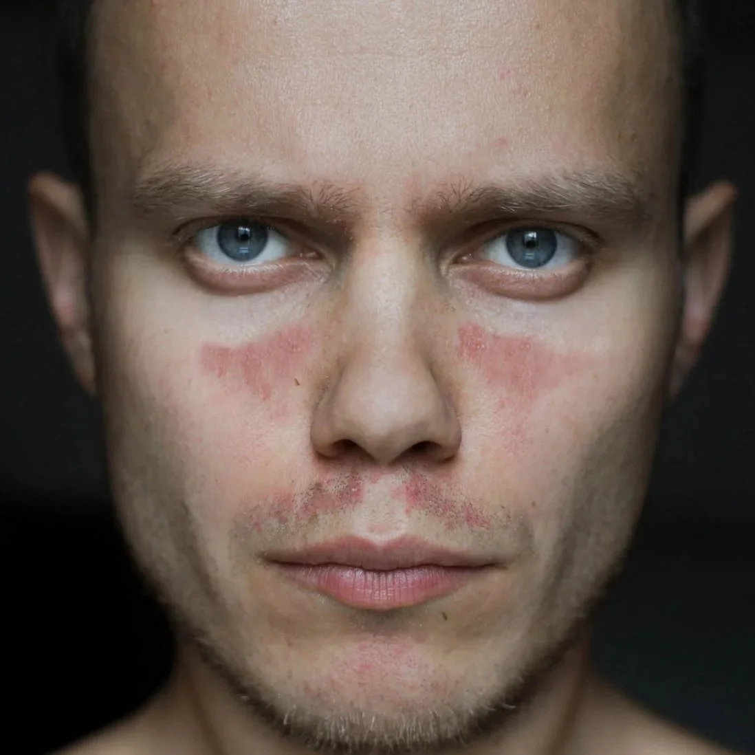 Close-up of a person's face with red marks and irritation, looking directly at the camera.