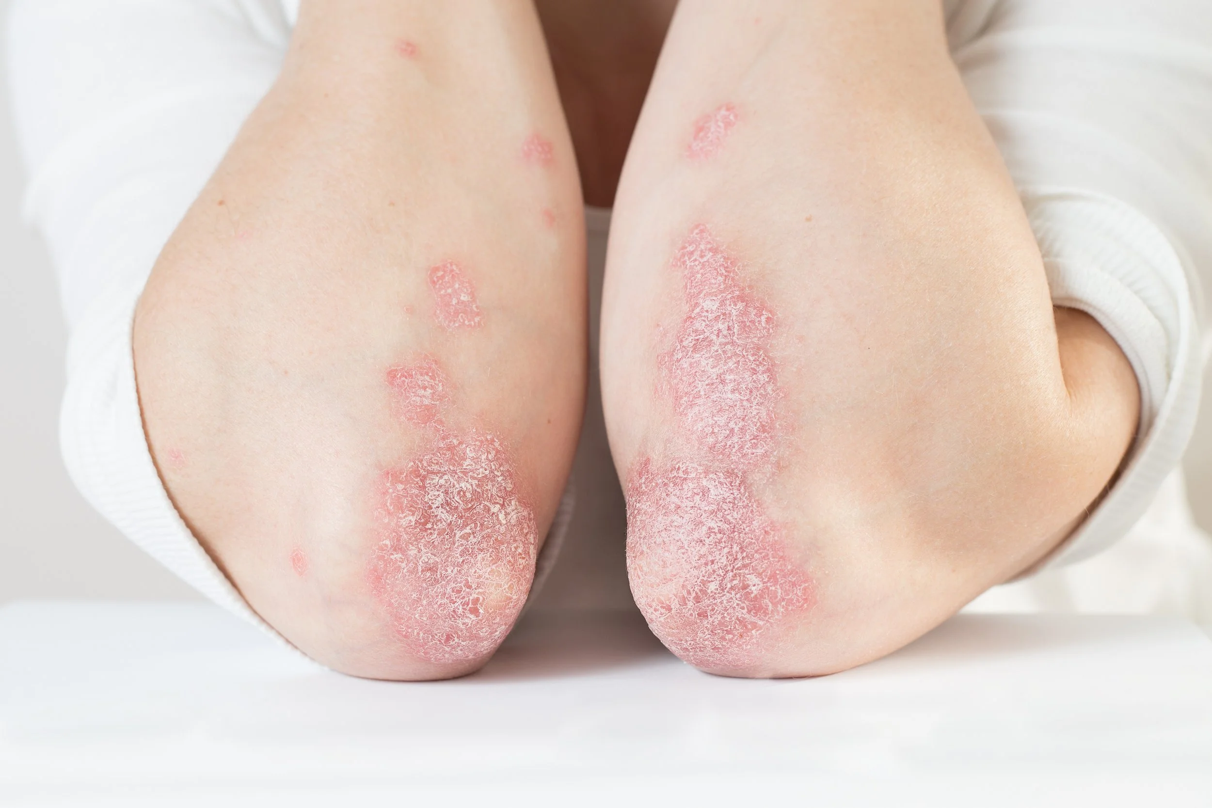 Close-up of heels with red, scaly, peeling patches of dry skin typical of severe cracked heels.