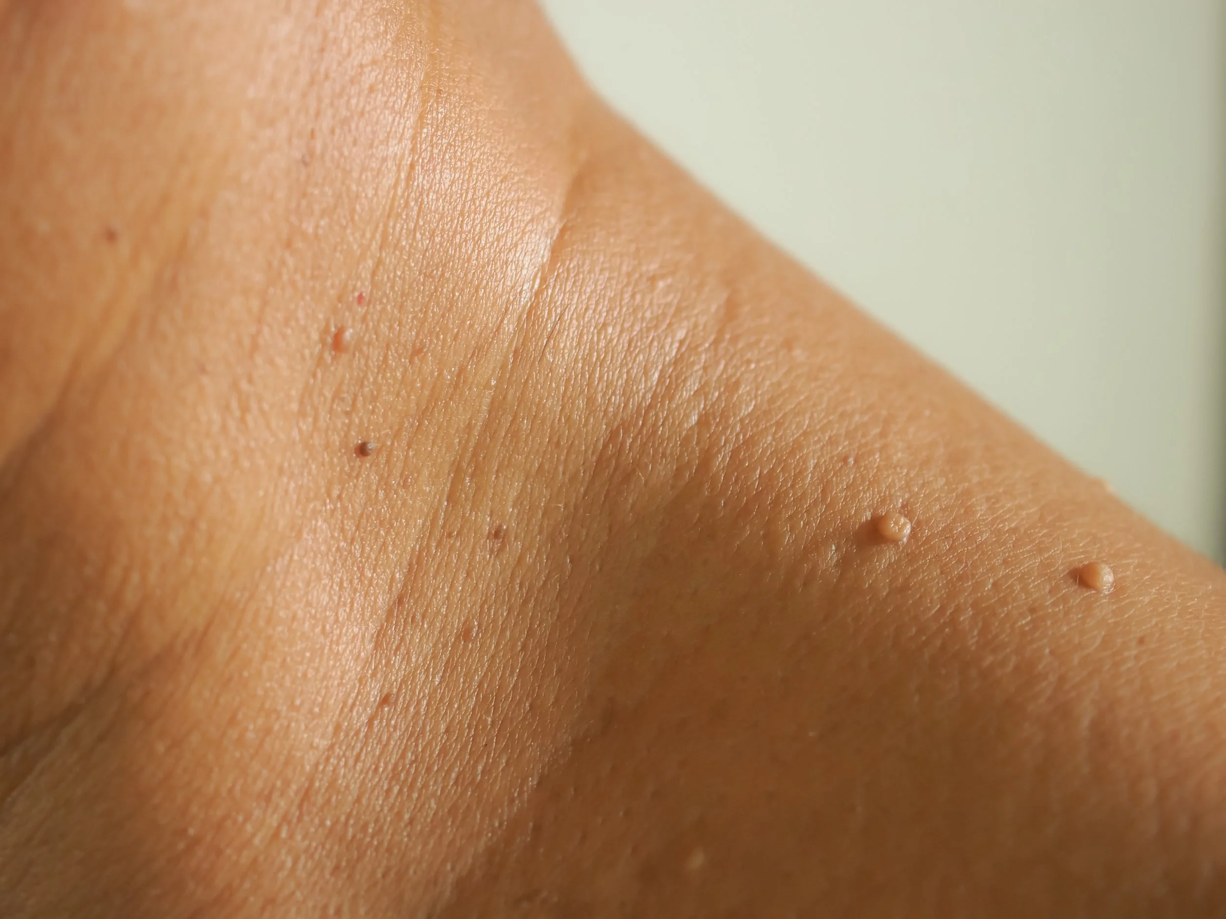Close-up of a person’s skin with small bumps and fine texture.