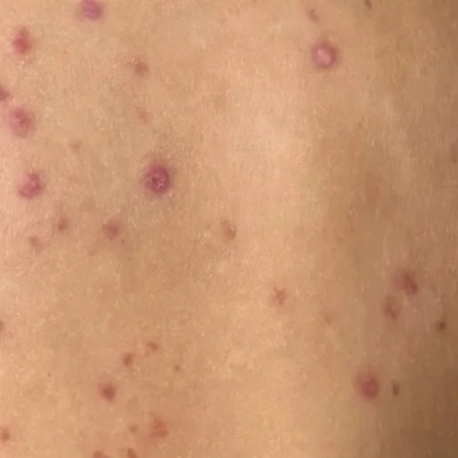 Close-up of skin with multiple red spots and pimples.