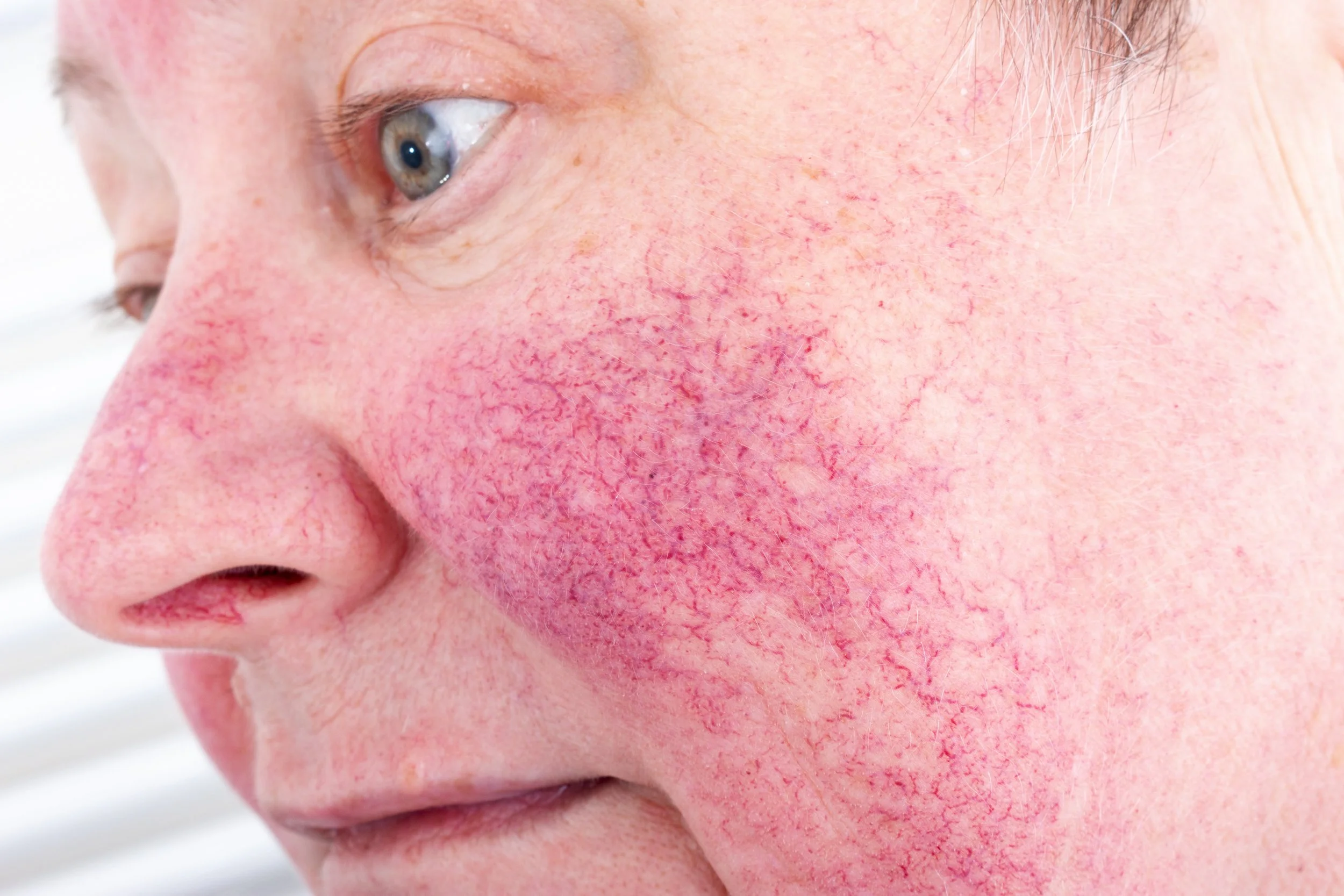 Close-up of a person's face showing redness, inflammation, and visible blood vessels, indicating a skin condition.