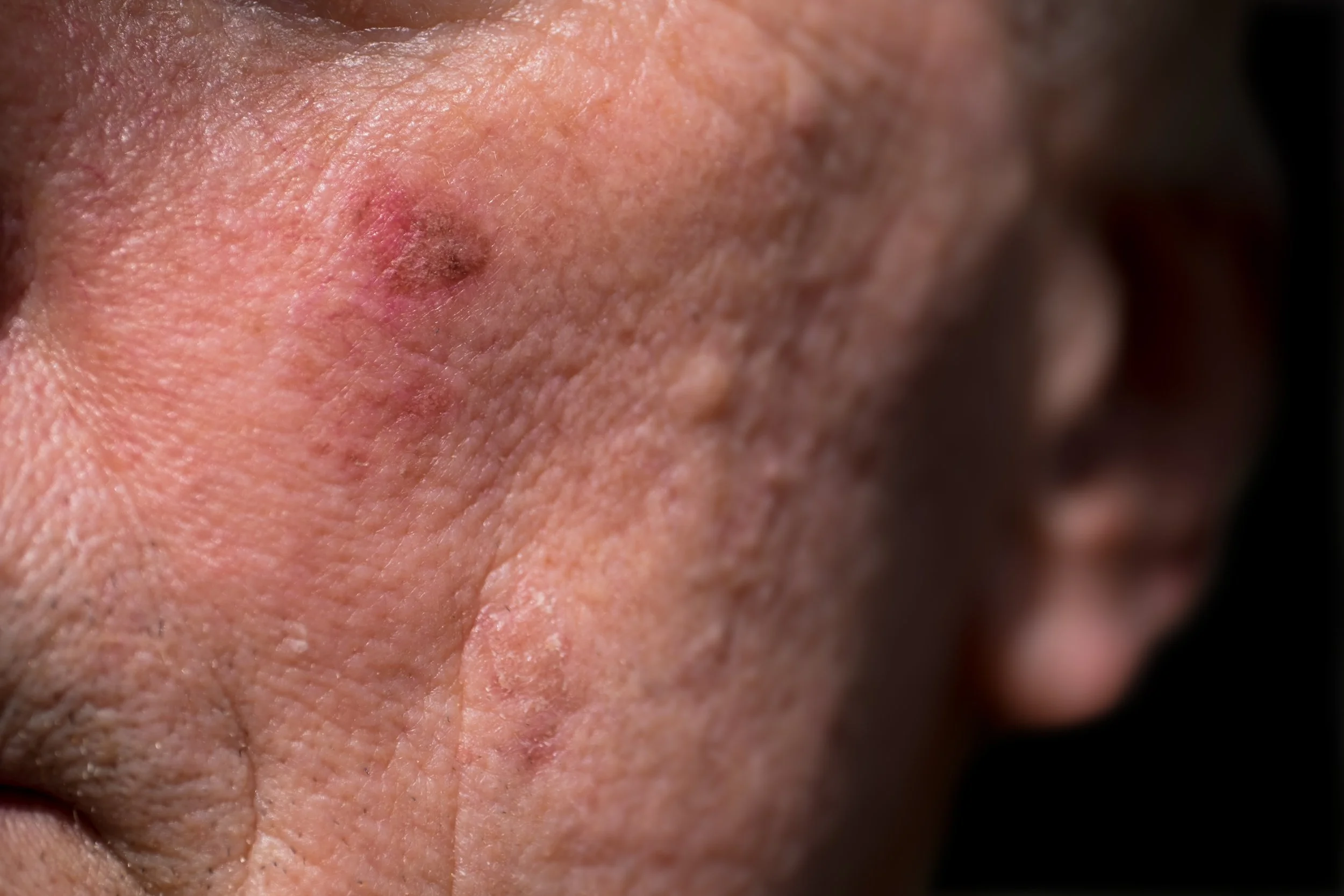 Close-up of a person's skin showing blemishes, dark spots, redness, and uneven texture.