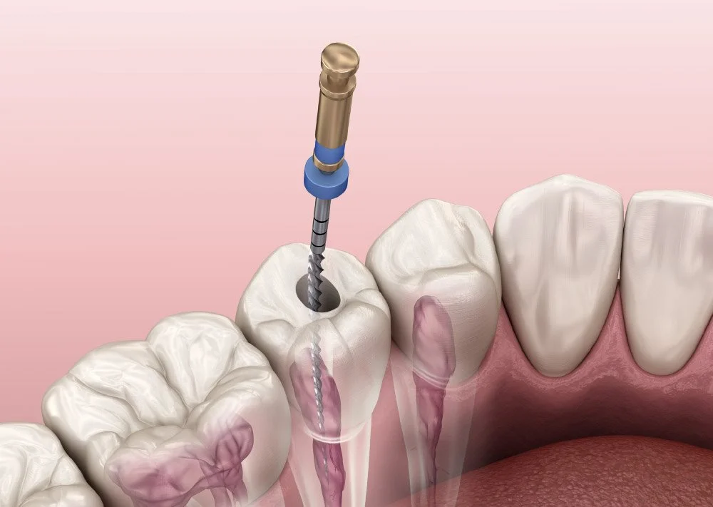 A dental procedure involving a dental drill inside a tooth, with surrounding teeth and gum tissue visible.