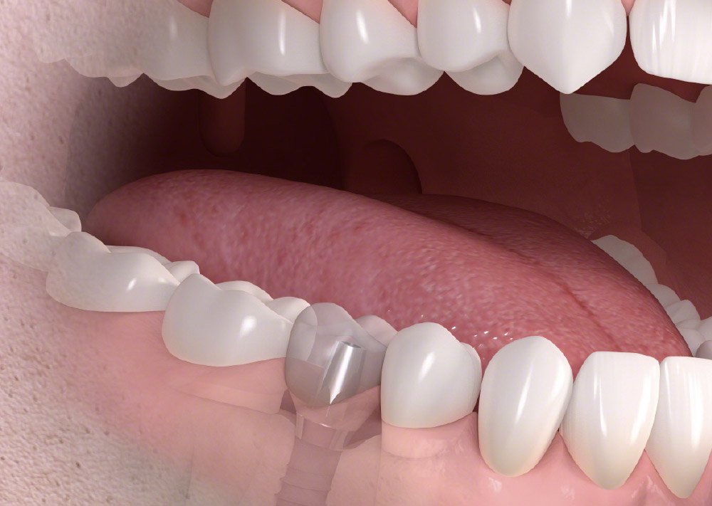 Close-up of open mouth showing teeth, tongue, and oral cavity with a dental crown on one of the lower molars.