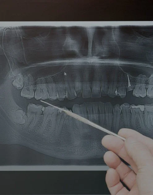 A dental X-ray showing a person's teeth and jaw, with a hand holding a dental instrument pointing at the lower teeth.