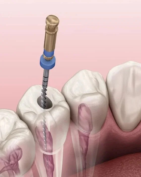 An illustration of a dental drill used for root canal treatment inside a tooth with surrounding teeth and gums.