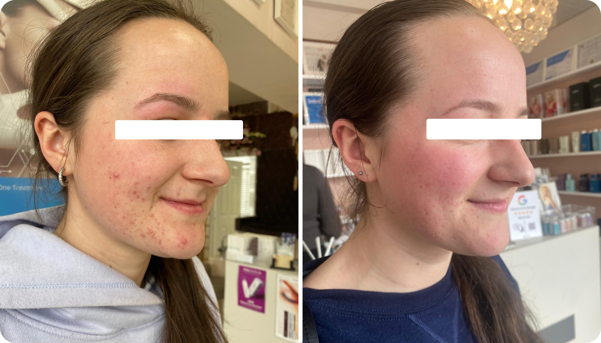 Side-by-side comparison of a young woman's face before and after skincare treatment. The left image shows her with acne and redness; the right image shows her with clearer, smoother skin.
