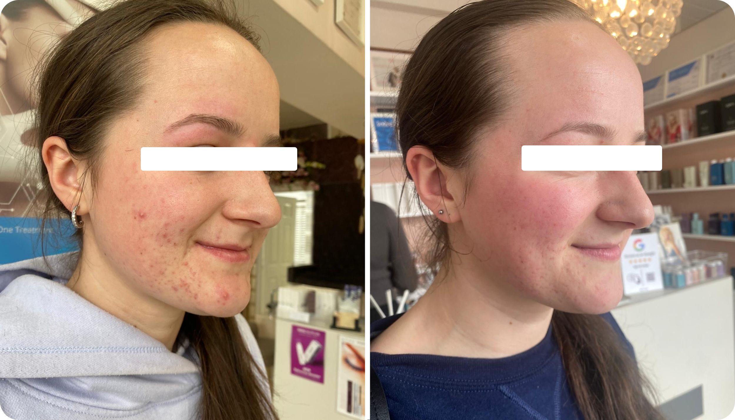 Side-by-side close-up images of a young woman with clear skin in the second photo, showing improved skin condition compared to the first photo with acne and skin redness.