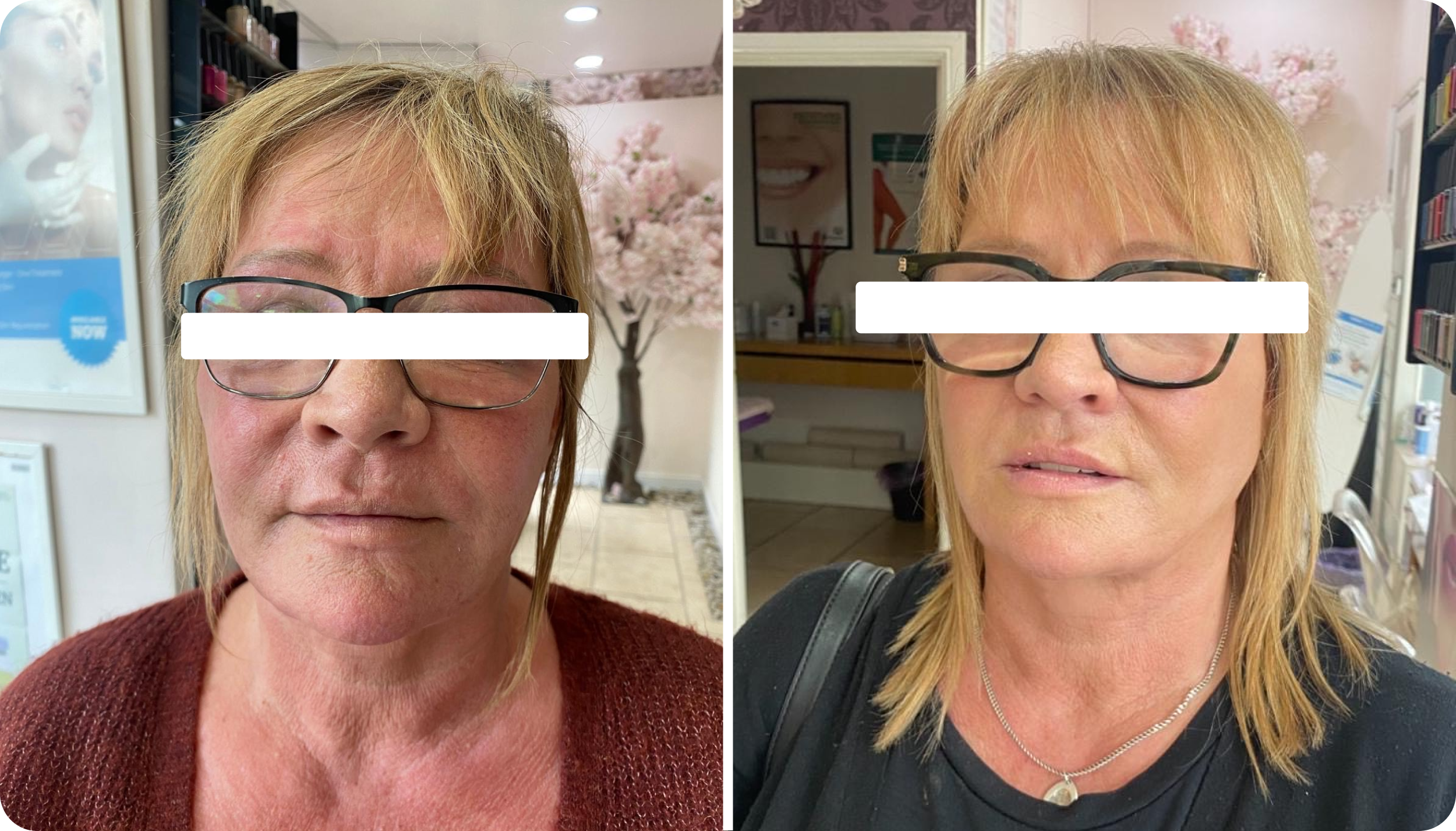 Side-by-side comparison of a woman before and after a hair makeover, wearing glasses, with a pink cherry blossom background.