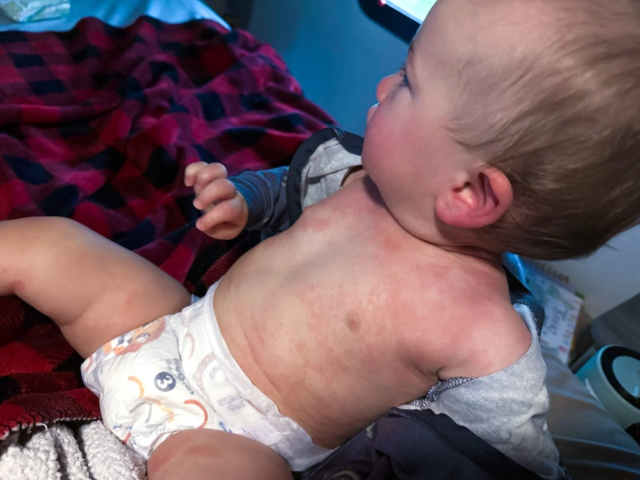Toddler with a red rash across his chest, stomach, back and legs while camping at Devils Fork State Park.