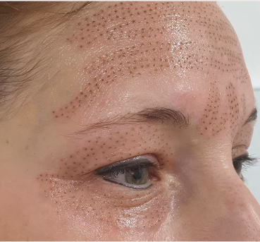 plasma pen treatment