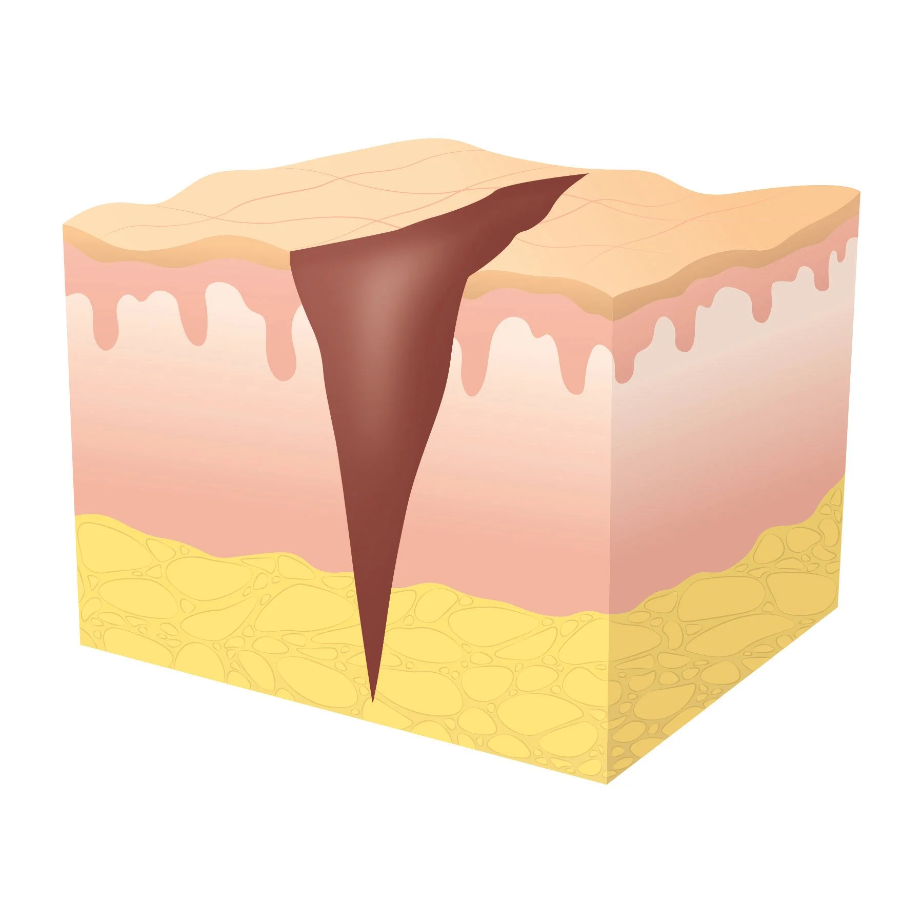 Illustration of tertiary wound healing at stage one showing an infected wound.  