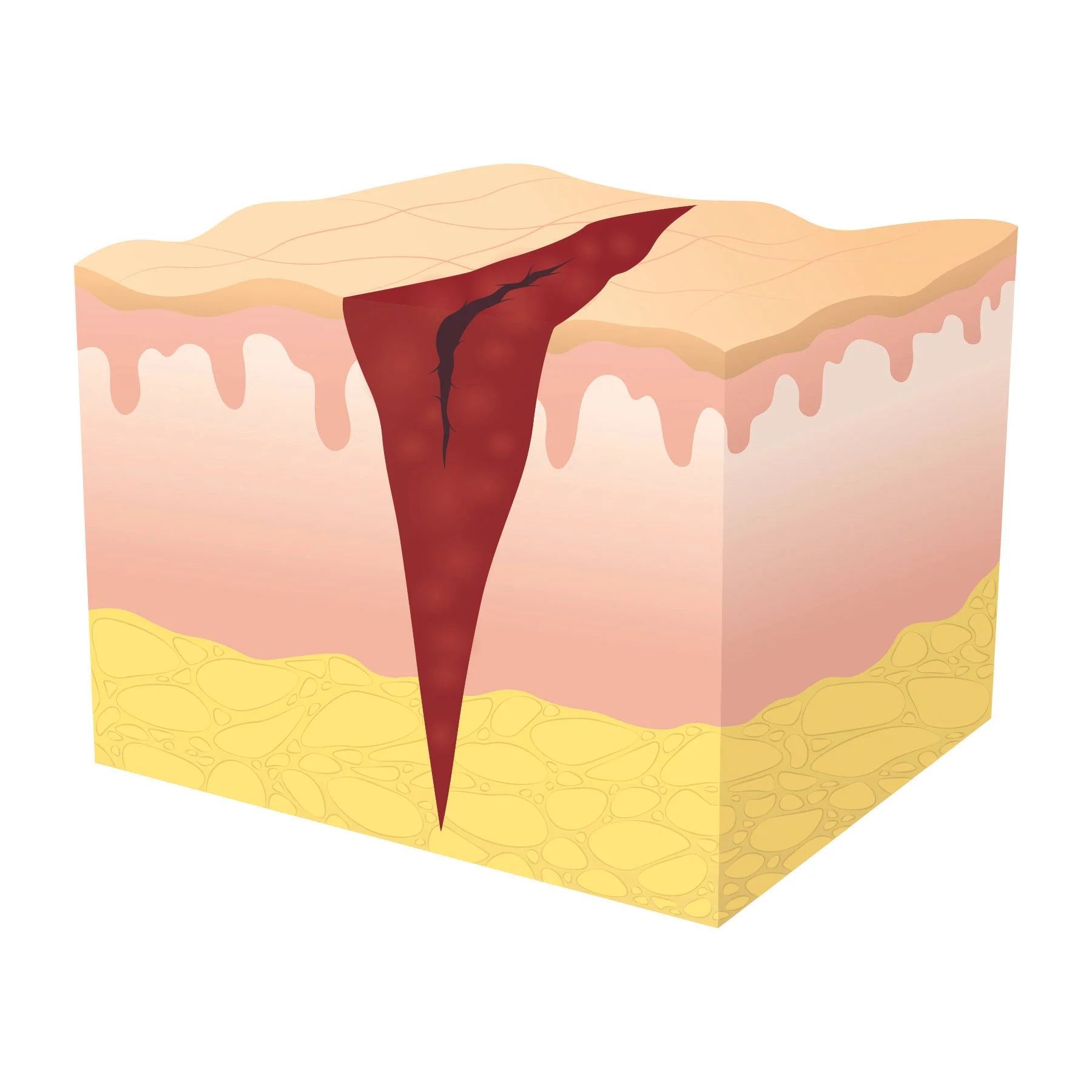 Illustration of tertiary wound healing at stage two, showing formation of granulation tissue. 