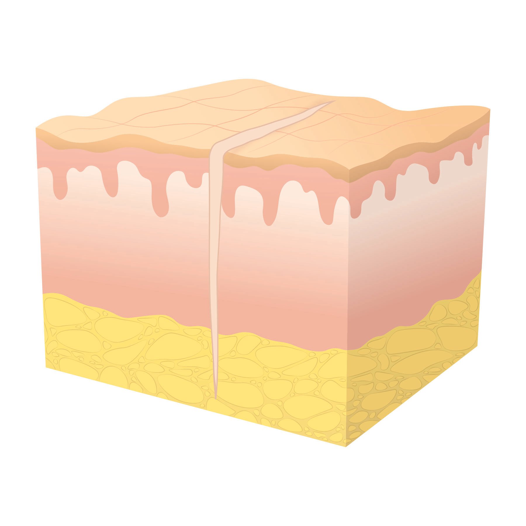 Illustration of primary wound healing at stage three showing a 'hairline' scar. 