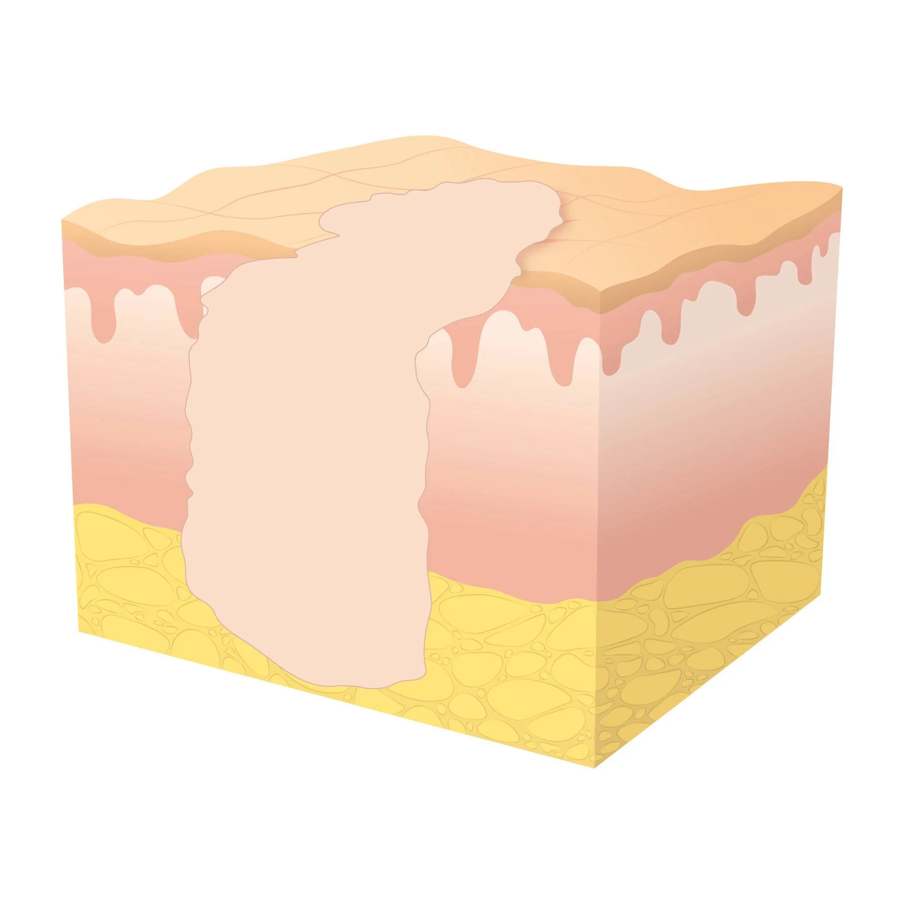 Illustration of secondary wound healing at stage three, showing a large scar. 