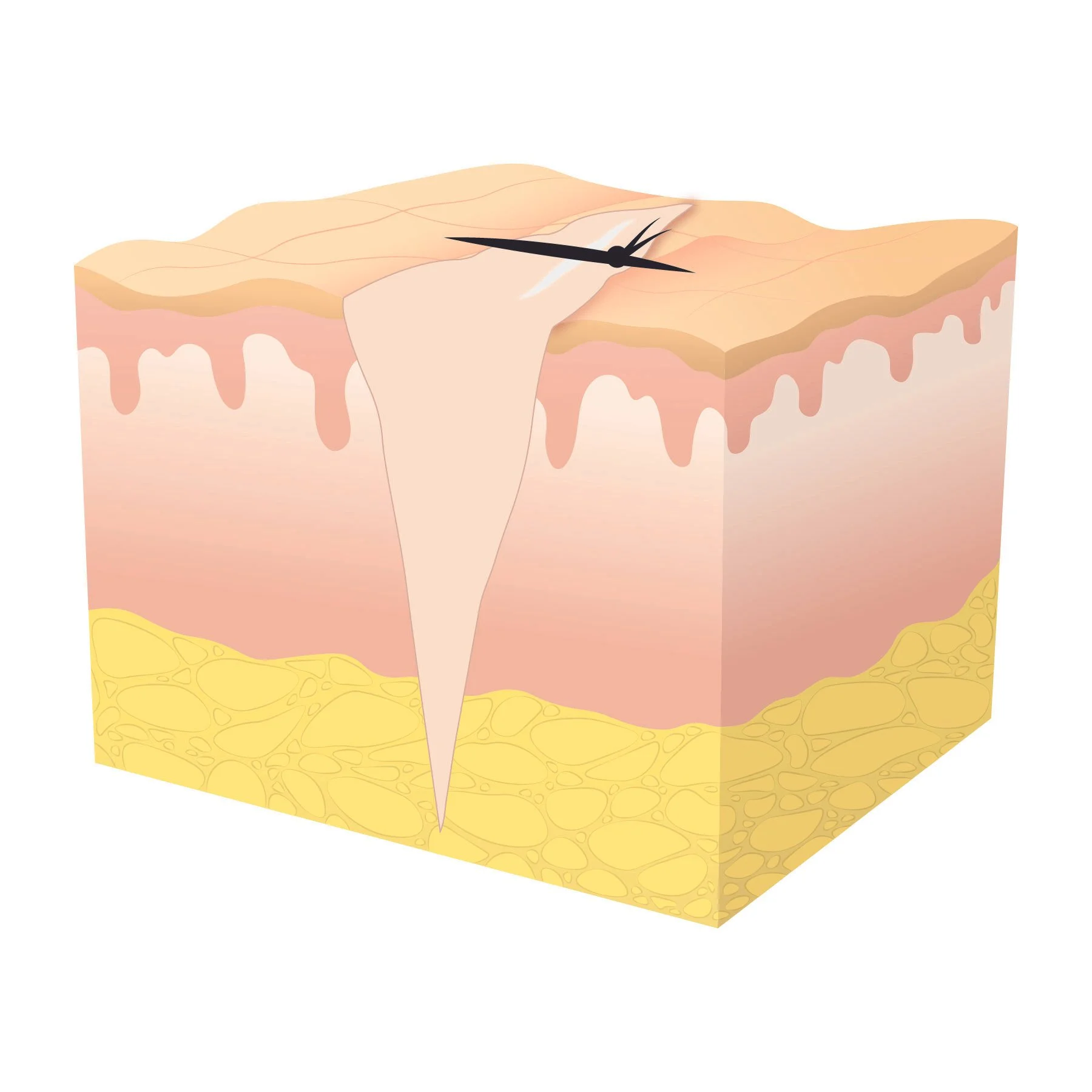 Illustration of tertiary wound healing at stage three, showing a suture with large scar. 