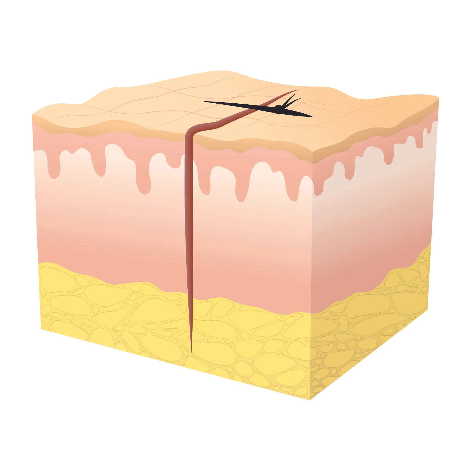 Illustration of primary wound healing at stage two, showing an early suture.  