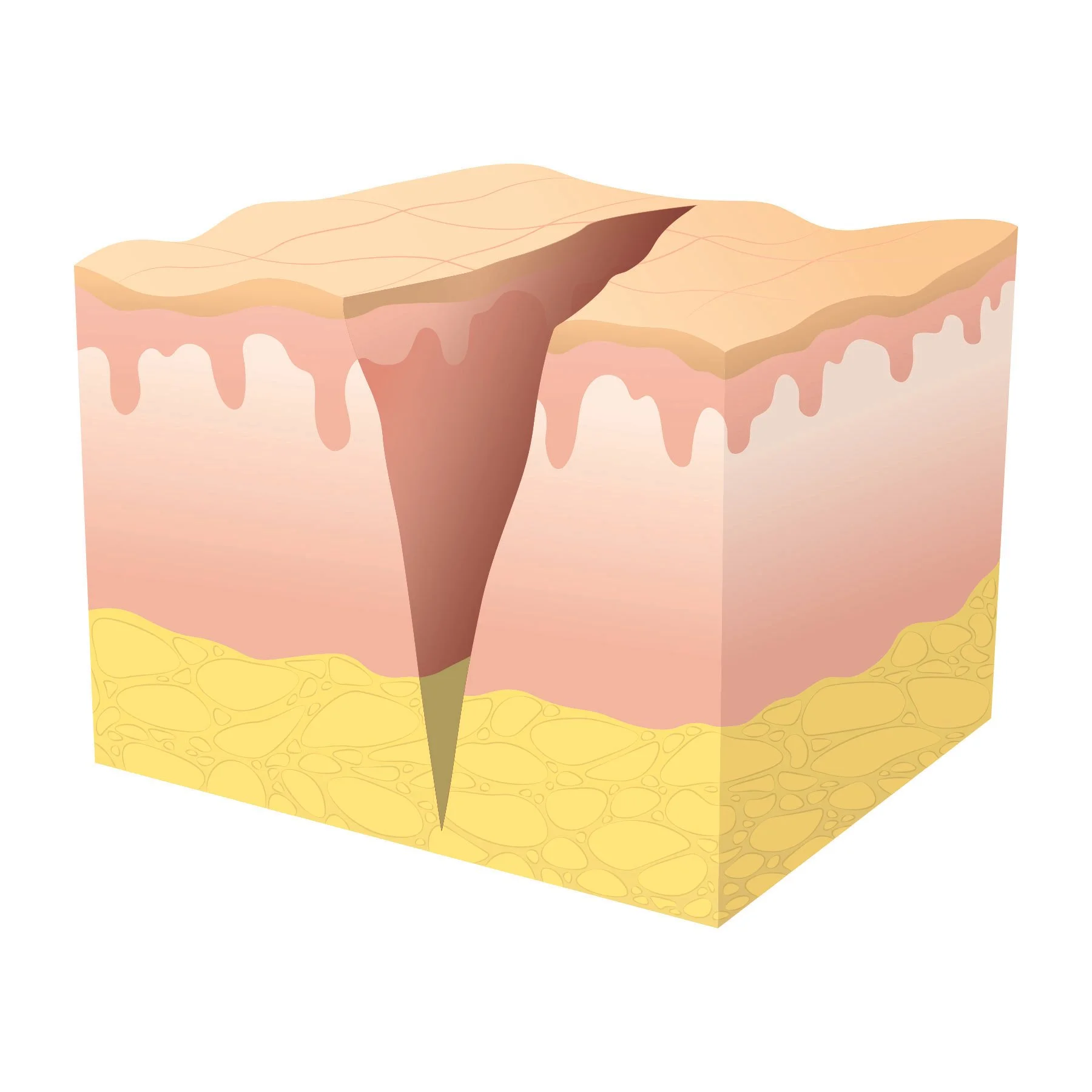 Illustration of primary wound healing at stage one showing a clean incision. 