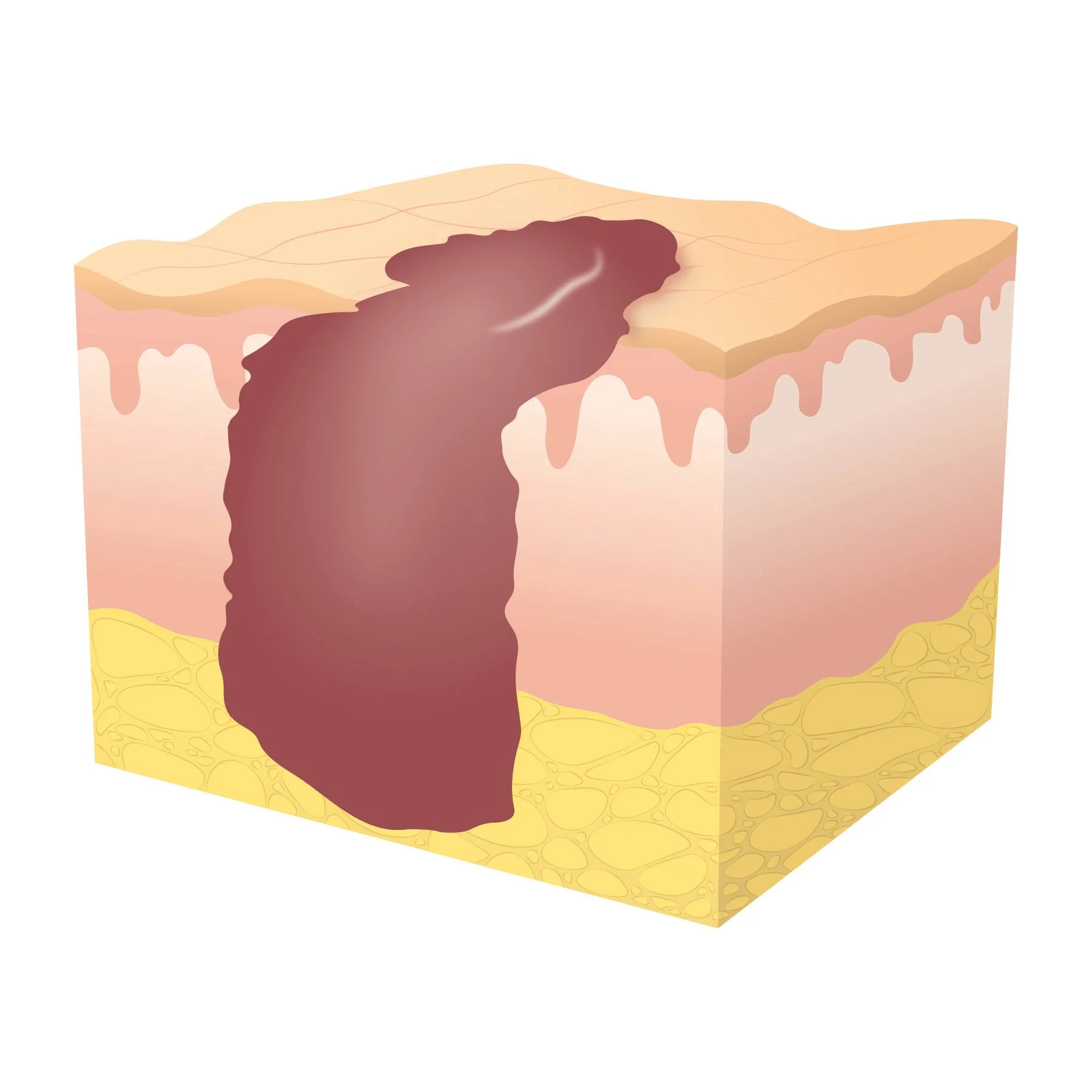 Illustration of secondary wound healing at stage one showing a large wound with blood clotting. 