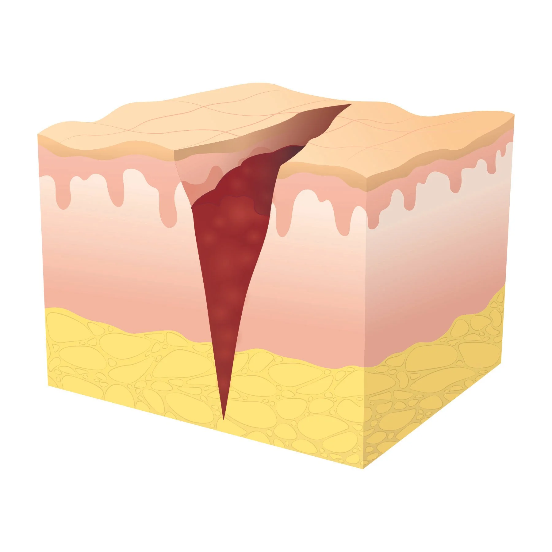 Illustration of secondary wound healing at stage two, showing formation of granulation tissue. 
