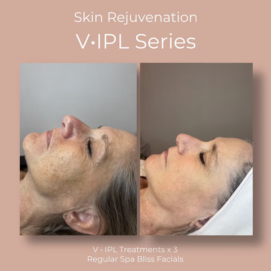 Before and after photos of a woman's face showing skin rejuvenation from V-IPL series treatments.