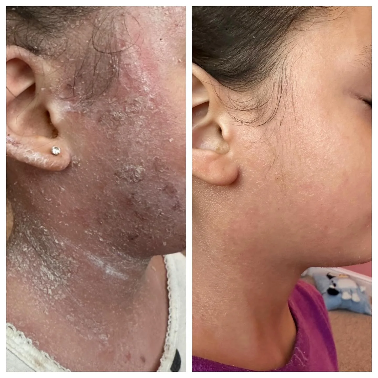 This is what healing looks like. Eczema, psoriasis, perioral dermatitis, mystery rashes, etc. They&rsquo;re not just skin deep. They&rsquo;re signs of internal imbalance&hellip; immune dysregulation, lymphatic stagnation, nervous system overload, and
