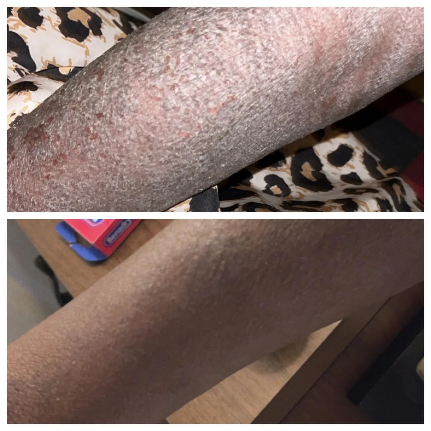 This client presented with severe, full-body topical steroid withdrawal, including diffuse inflammation, scaling, xerosis, and pustular lesions on the arms. The skin barrier was significantly compromised at intake.

Care began less than two months ag