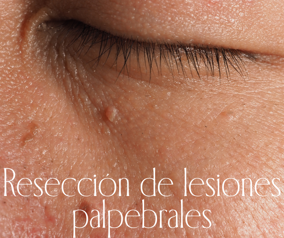 RESECCIÓN DE LESIONES PALPEBRALES