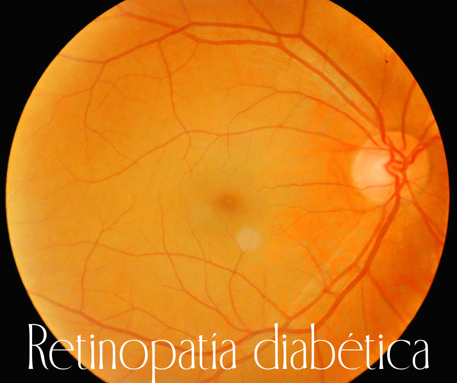 DETECCIÓN Y MANEJO DE LA RETINOPATÍA DIABÉTICA