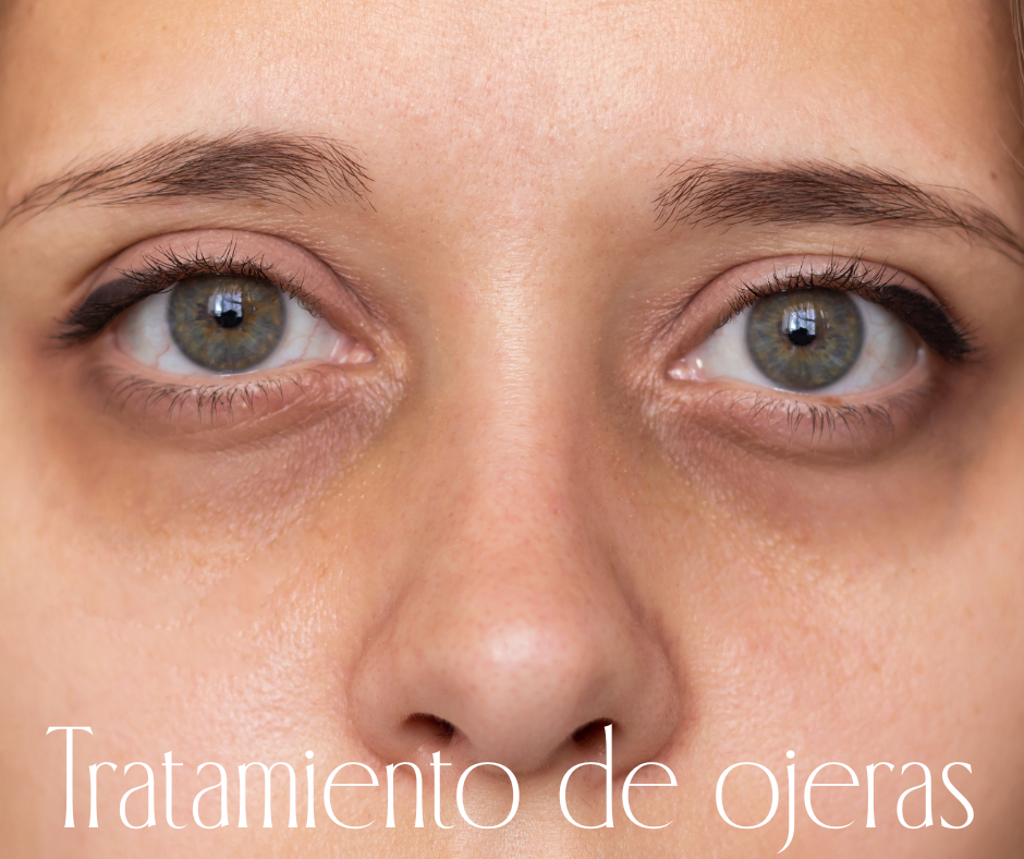 TRATAMIENTO PARA OJERAS