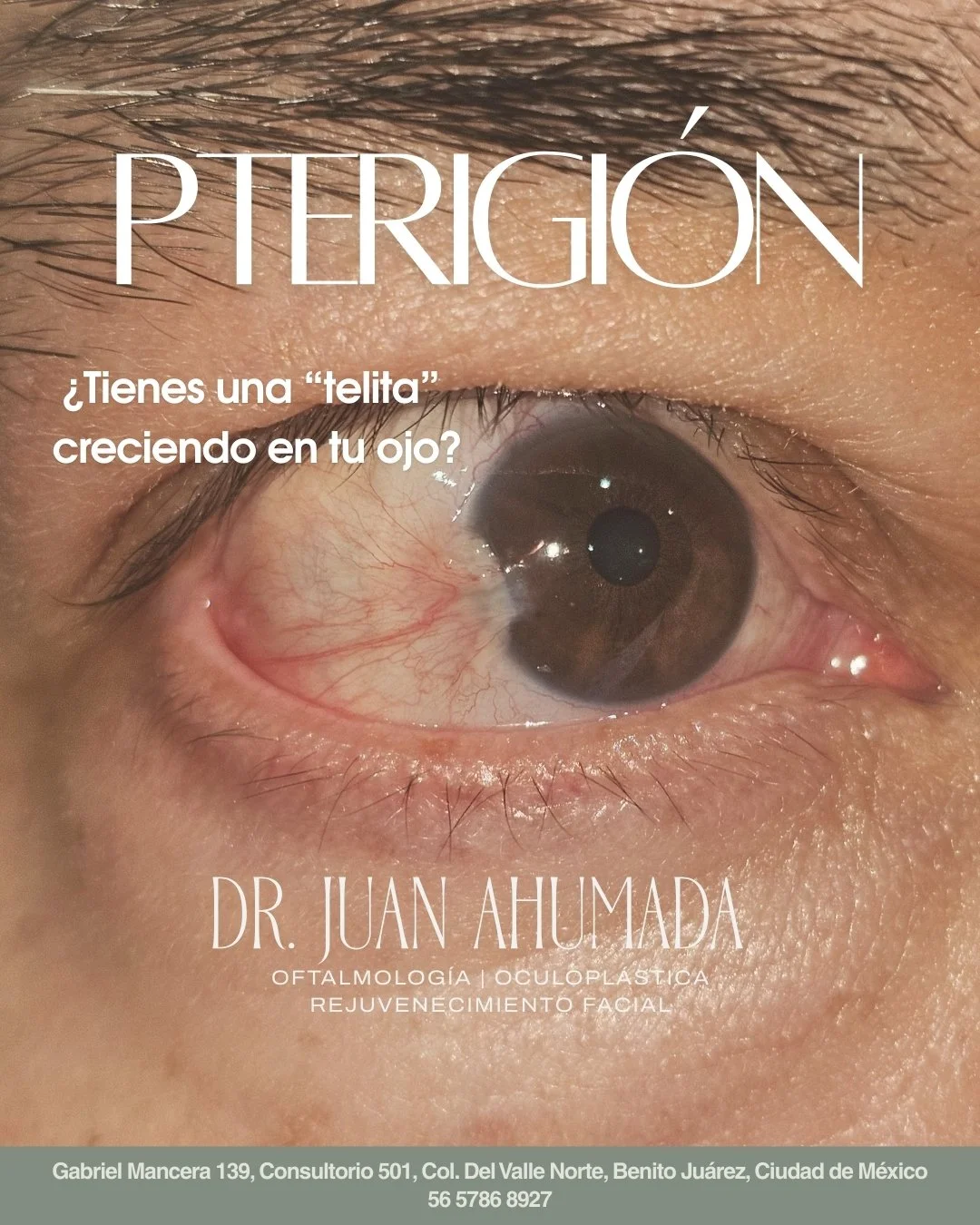 🌤️ &iquest;&ldquo;Carnosidad&rdquo; en el ojo que crece?
👁️ El pterigi&oacute;n puede afectar tu visi&oacute;n si no se trata
🔬 Tratamiento oportuno = mejor pron&oacute;stico

📩 Agenda tu valoraci&oacute;n oftalmol&oacute;gica

Citas: 56 5786 892
