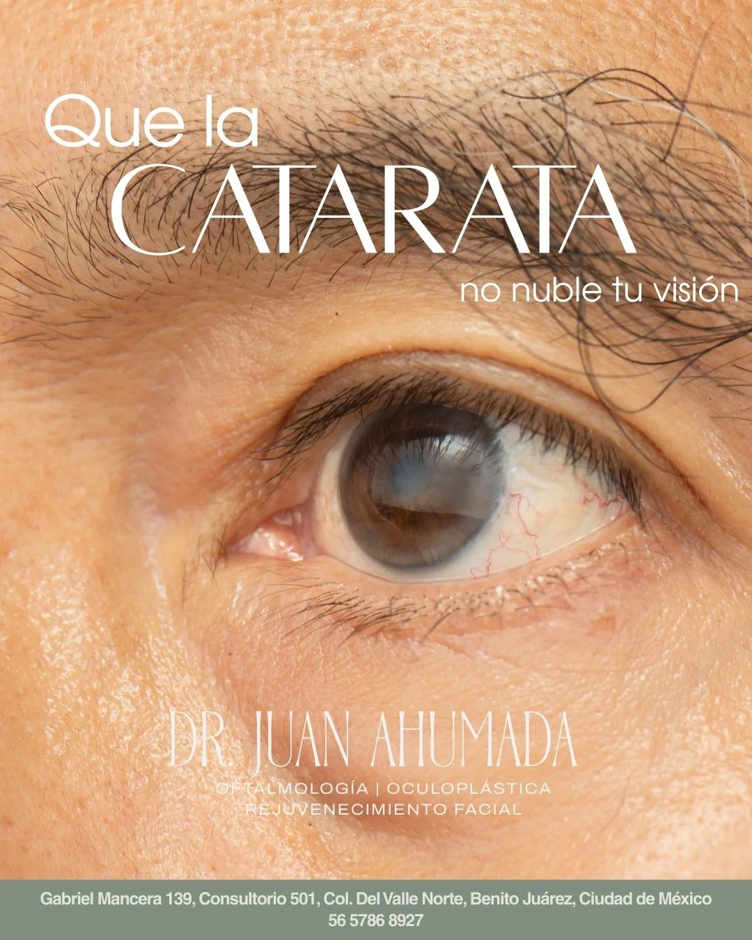🌫️ &iquest;Ves borroso o como con neblina?
👁️ Puede ser catarata
✨ La cirug&iacute;a te devuelve claridad y calidad de vida

📩 Agenda tu valoraci&oacute;n

Citas: 56 5786 8927
Gabriel Mancera 139, Piso 5, Consultorio 501, Col. del Valle Norte, Ben