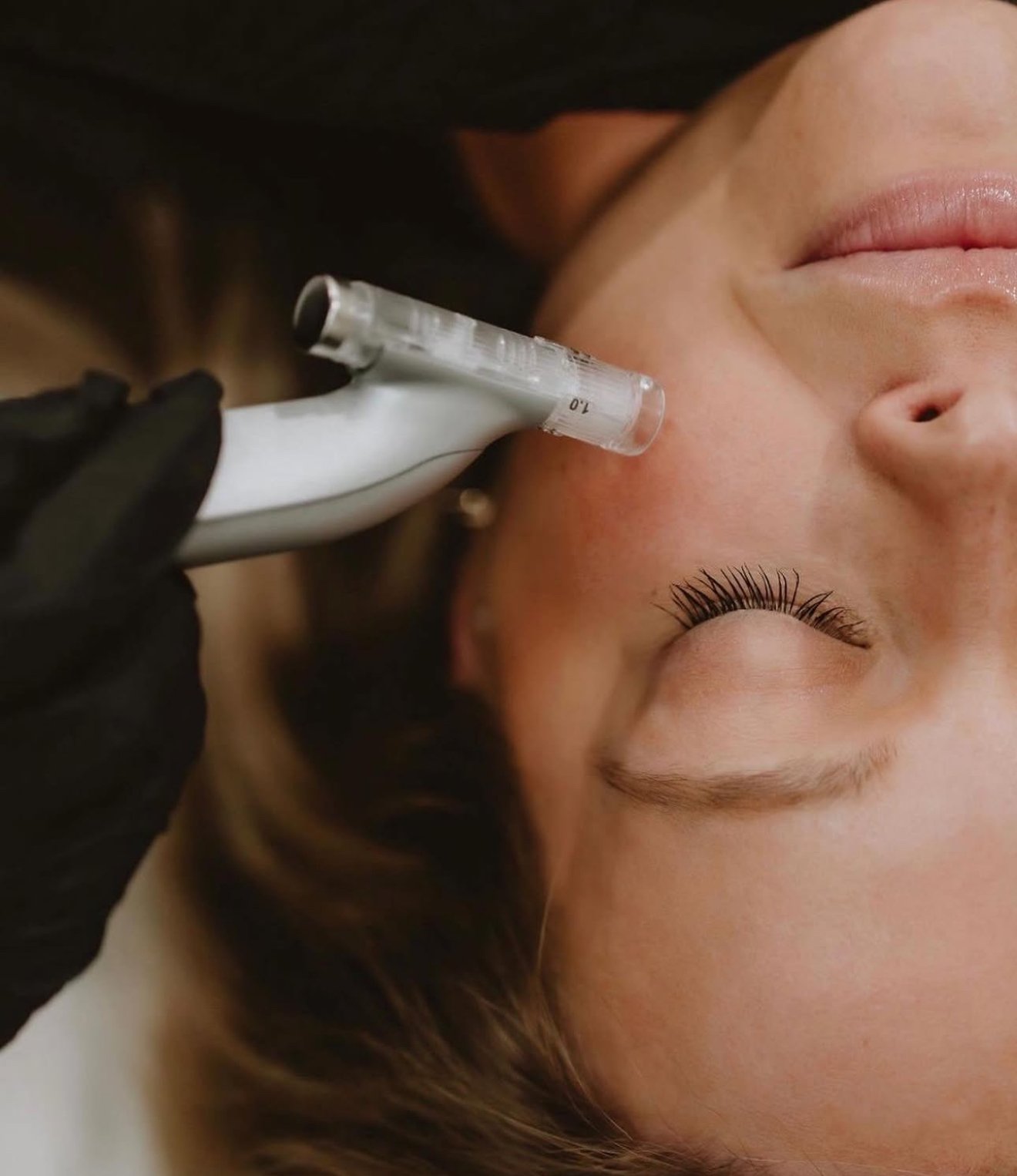 MICRONEEDLING EXPLAINED