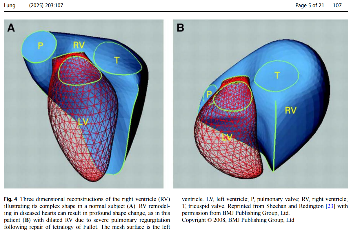 Acute Right Ventricular Failure in the Medical ICU — Critical care insights