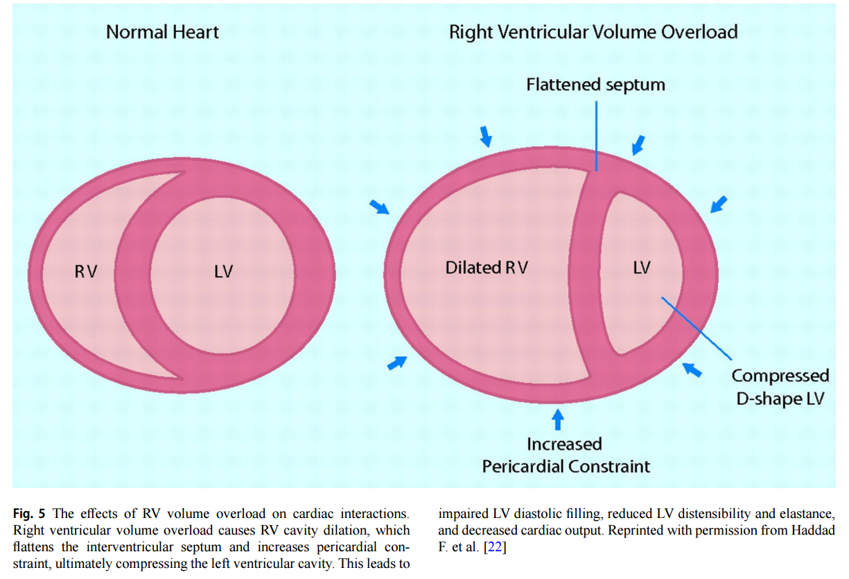 Acute Right Ventricular Failure in the Medical ICU — Critical care insights