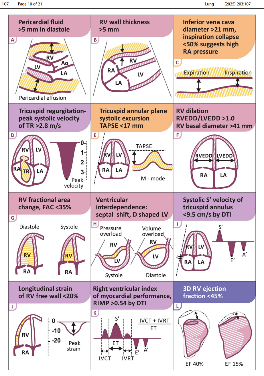 Acute Right Ventricular Failure in the Medical ICU — Critical care insights