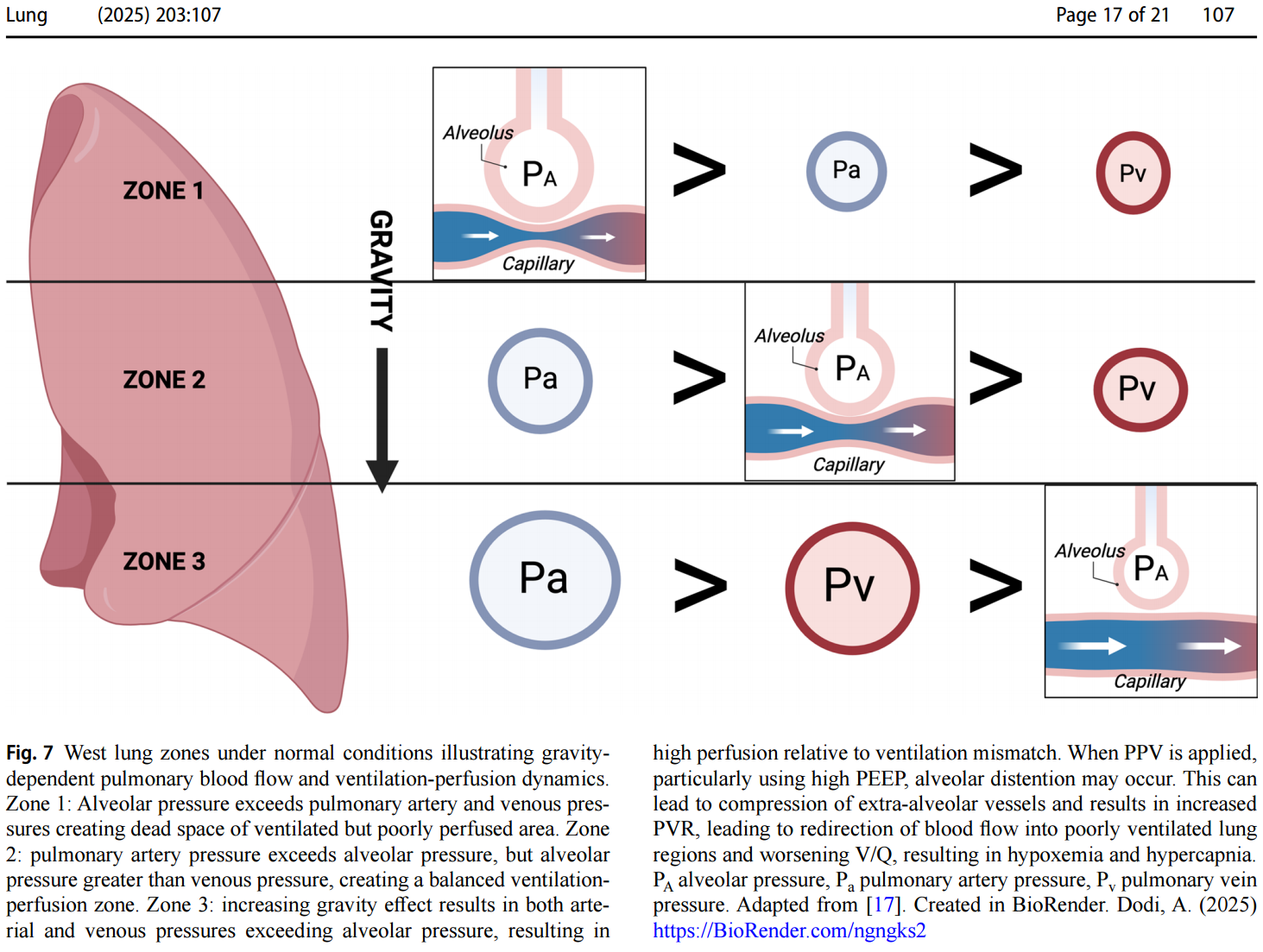 Acute Right Ventricular Failure in the Medical ICU — Critical care insights