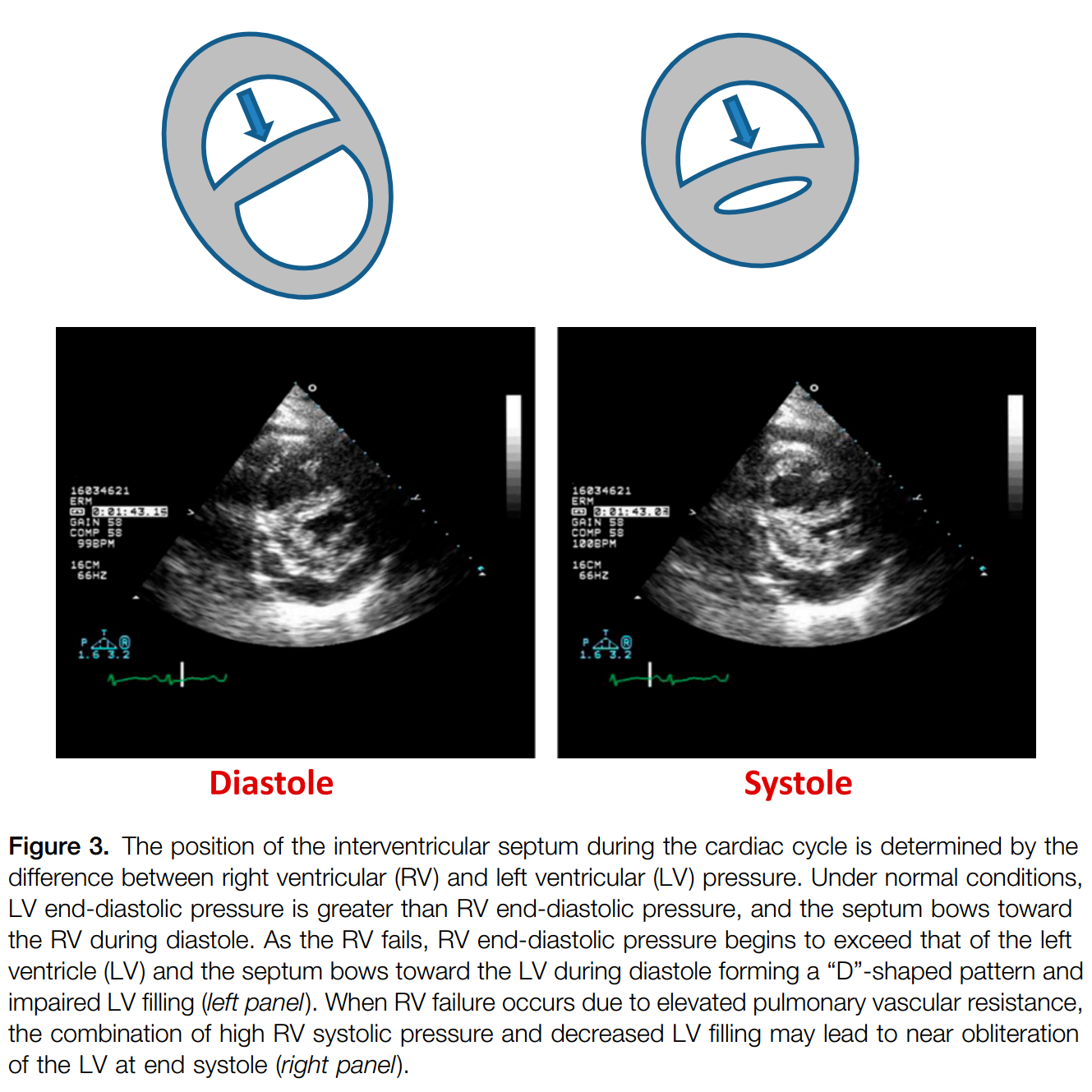 Management of Acute Right Ventricular Failure in the Intensive Care ...