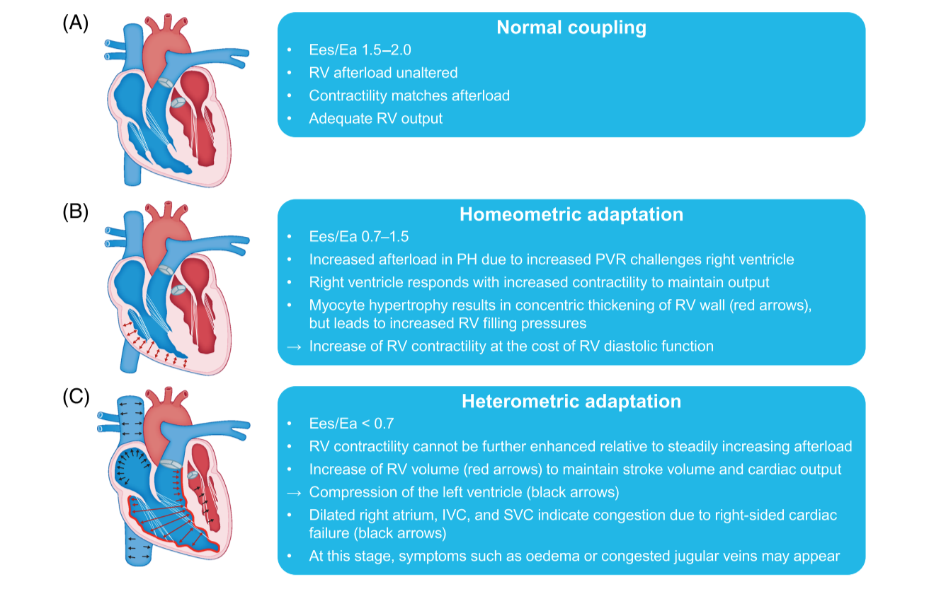 Adaptive versus maladaptive right ventricular remodelling