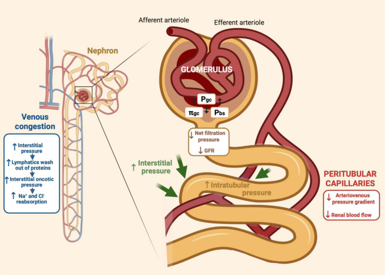 Renal congestion syndrome in critically ill patients : a neglected mechanism of acute kidney injury - A narrative review