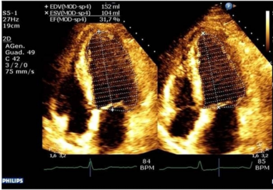 Ventriculoarterial decoupling in human septic shock