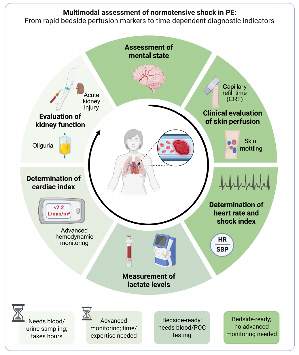 Acute pulmonary embolism : clinical and echocardiographic recognition of normotensive shock