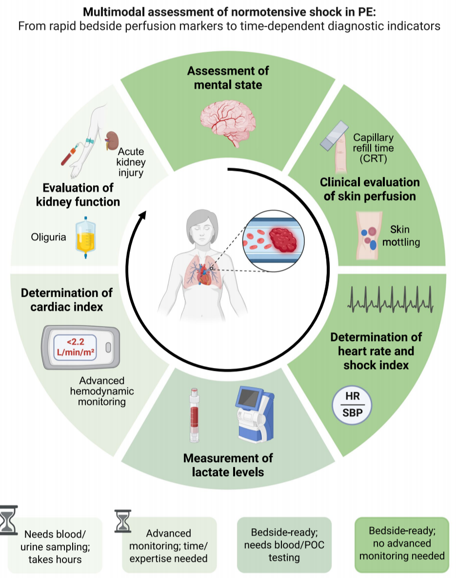 Acute pulmonary embolism : clinical and echocardiographic recognition of normotensive shock