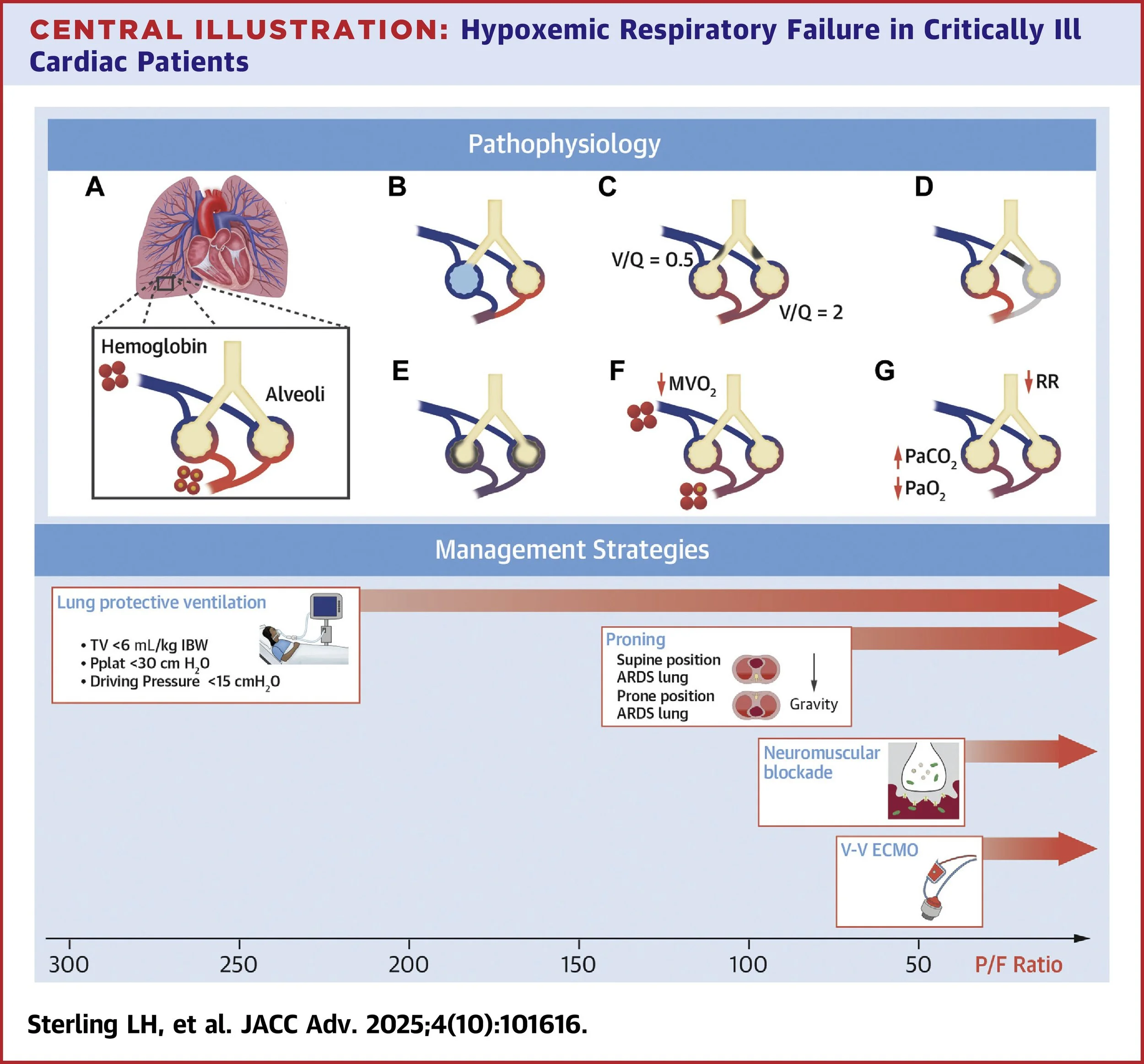 Navigating Hypoxemic Respiratory Failure in Critically Ill Cardiac Patients