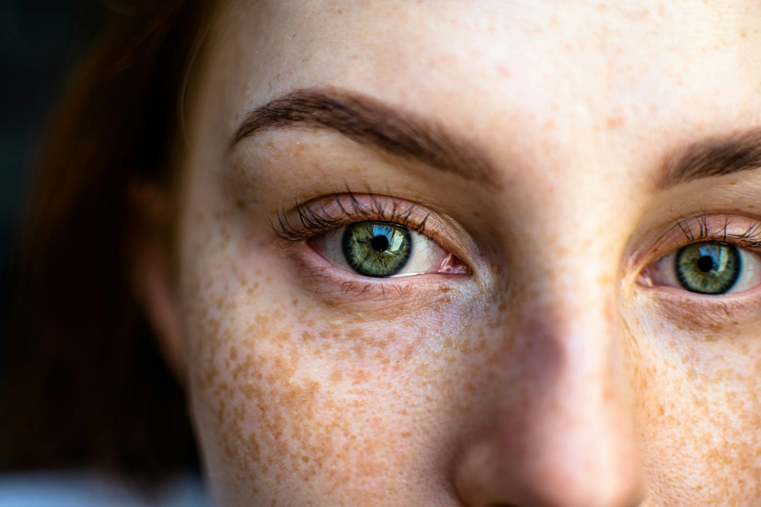 pigmentation and melasma