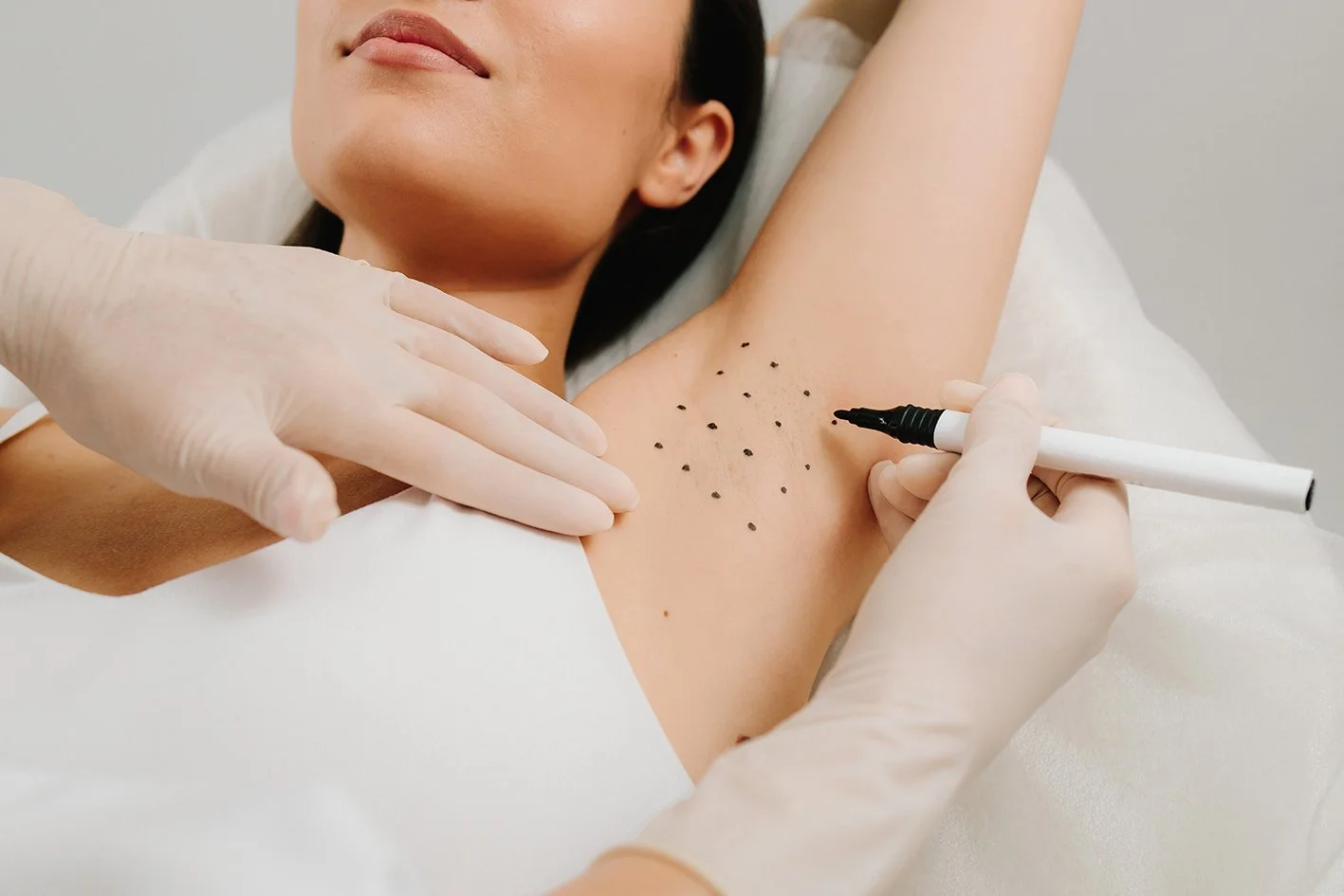 Excessive sweating Hyperhydrosis Mind Body Skin Institute Bowral