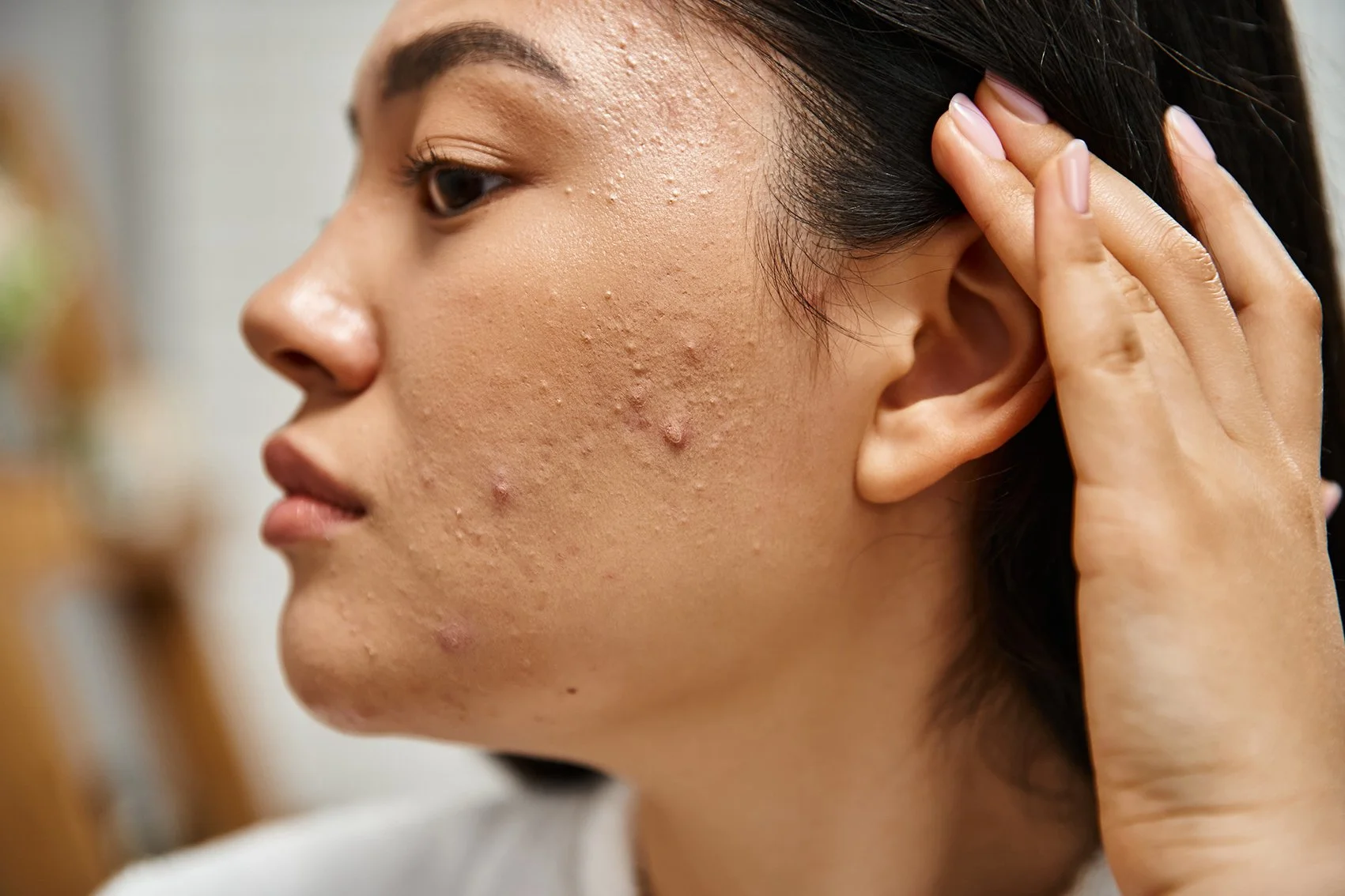 Acne and Acne Scarring Treatments Bowral Mind Body Skin Institute Southern Highlands, Dr Nicole Bowral, skin resurfacing bowral