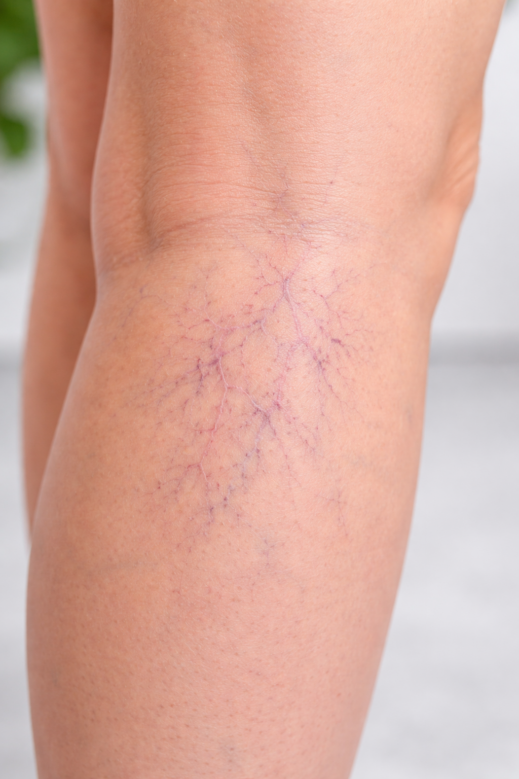 spider veins, sclerotherapy, leg veins, how to get rid of leg veins