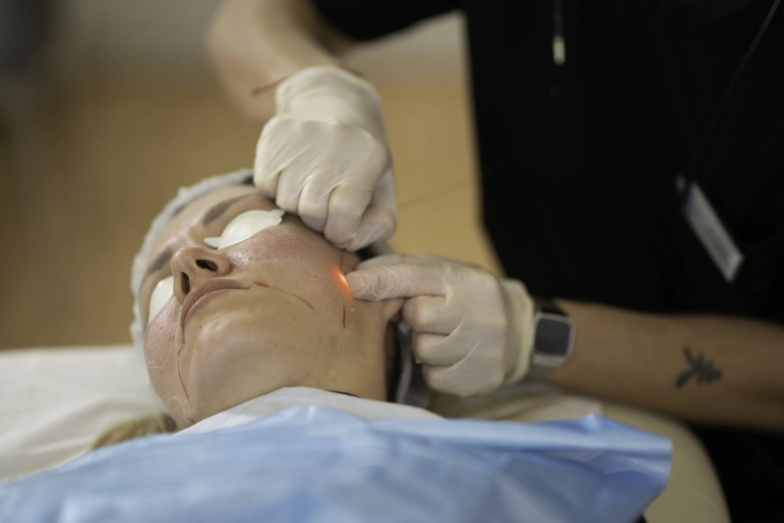 Endolift For Midface Lifting: The Subtle Facial Lift Without Surgery