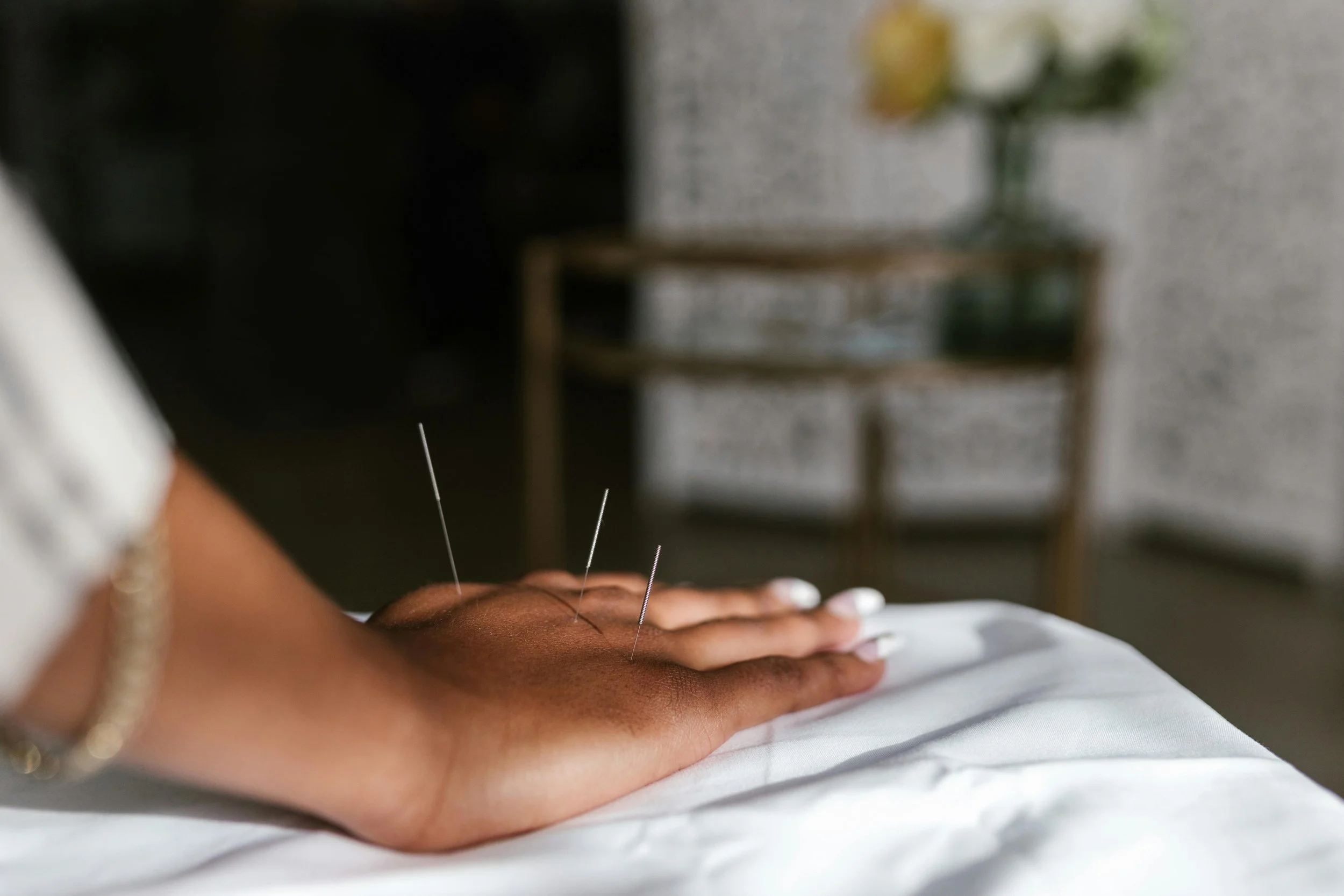 Acupuncture for fatigue: Person's hand with three acupuncture needles inserted, resting on a white cloth, with a blurred background of a small wooden table and a vase with flowers. 